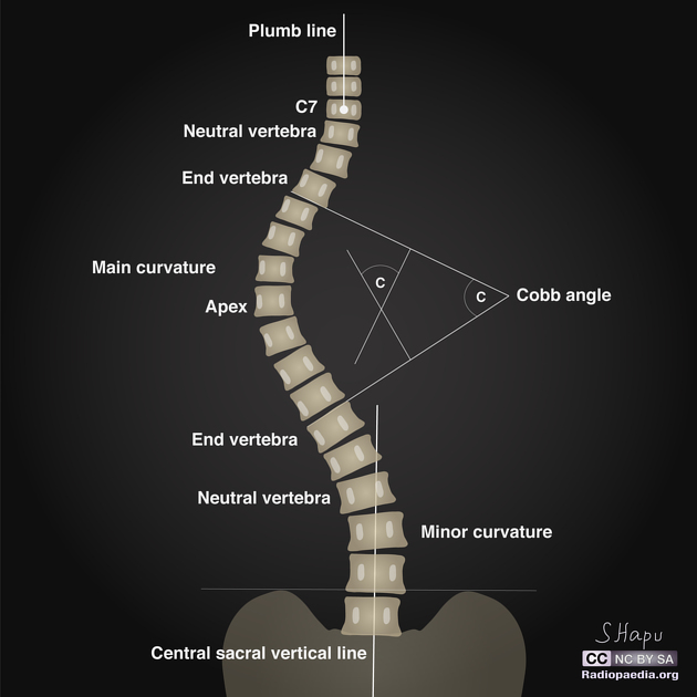 definitions-scoliosis.jpeg